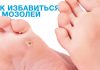 Как избавиться от мозолей — советы врача-ортопеда