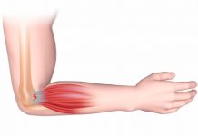 Что такое эпикондилит и как его лечить
