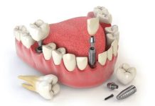 Ортопедическая стоматология: ключ к здоровью и красоте улыбки