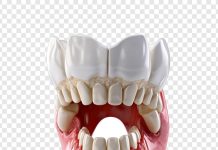 Реконструкция ВНЧС