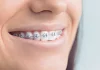 5 причин чтобы поставить брекеты