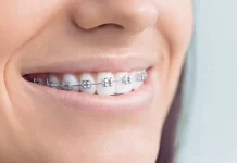 5 причин чтобы поставить брекеты