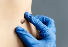 О чем могут говорить родинки на теле?