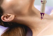 Удаление родинок у детей: особенности и риски