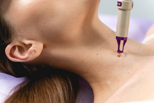 Удаление родинок у детей: особенности и риски